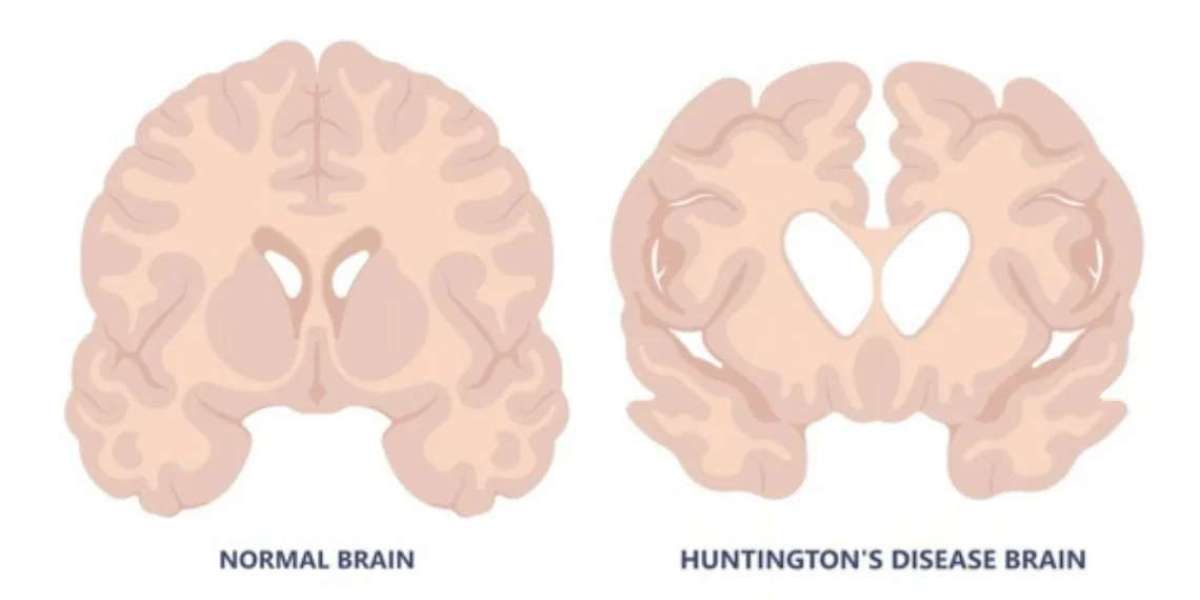 Breakthrough Gene Therapy Slows Huntington’s Disease by 75%