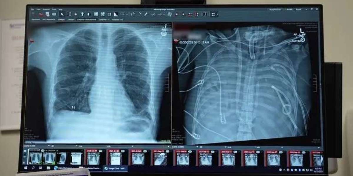 World First: Artificial Lung System Keeps Patient Alive for 48 Hours Without Natural Lungs