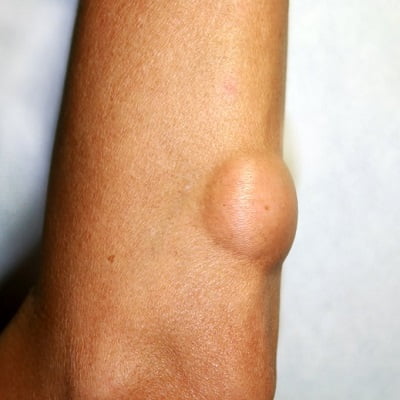 Best Lipoma-Treatment in Islamabad/ Rawalpindi - RCS