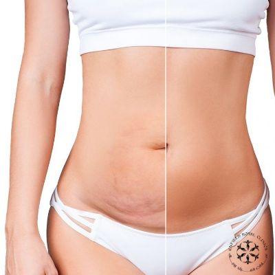 Fat Reduction Treatment in Islamabad, | ERC +923325488777