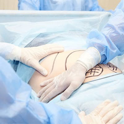 Best Liposuction Surgeon in Islamabad, Pakistan